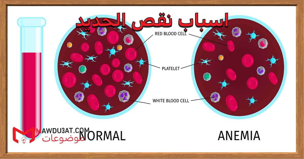 اسباب نقص الحديد